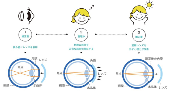 オルソケラトロジーの近視矯正法の詳細